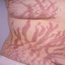 How to remove stretch marks on the stomach: developing an action plan